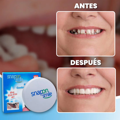 Carillas ajustables para sonrisa perfecta